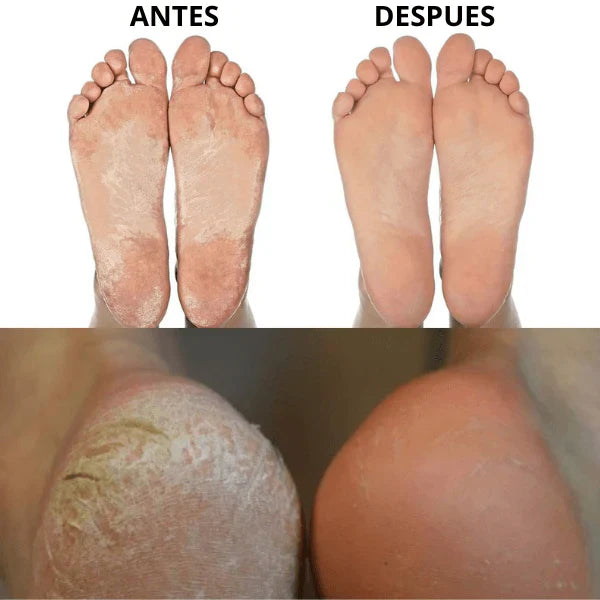 Removedor de Callos Eléctrico – Pies suaves al instante
