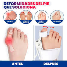 👣 Camina sin dolor: el corrector de juanetes que realmente funciona 👟 Diseñado para tus pies, pensado para tu salud! #Envio Gratis a toda Guatemala#